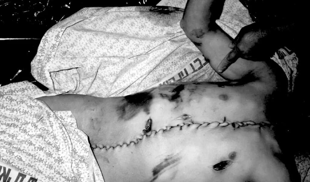 Body of a Palestinian prisoner, stitched from the chin to the abdomen, returned by the Zionist entity, in 1992. Photo: Donald Böstrom.