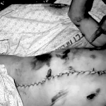 Body of a Palestinian prisoner, stitched from the chin to the abdomen, returned by the Zionist entity, in 1992. Photo: Donald Böstrom.