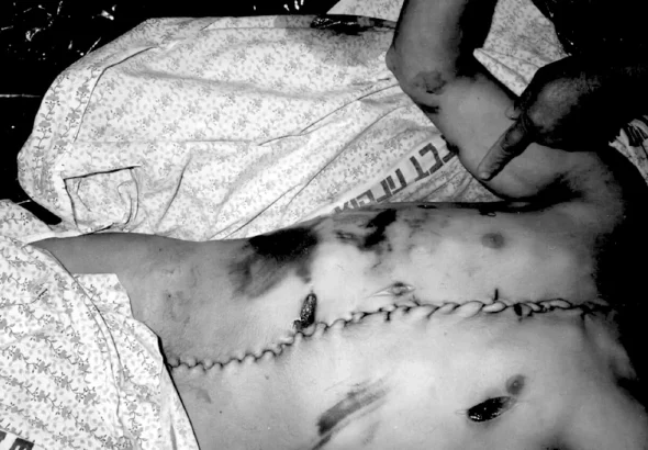 Body of a Palestinian prisoner, stitched from the chin to the abdomen, returned by the Zionist entity, in 1992. Photo: Donald Böstrom.